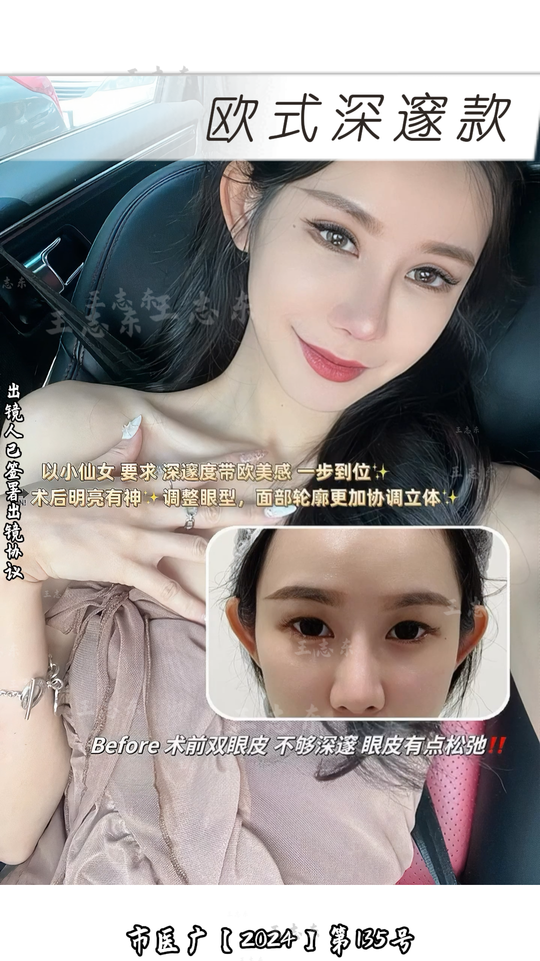 1.5双眼皮1.png