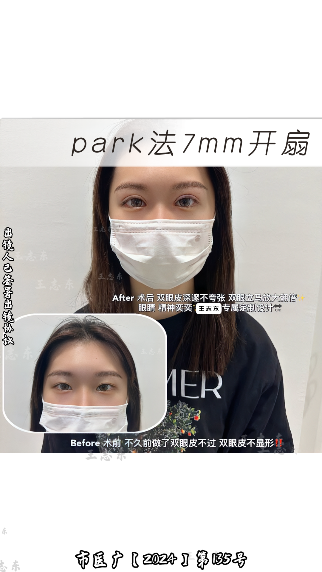 1.5双眼皮2.png