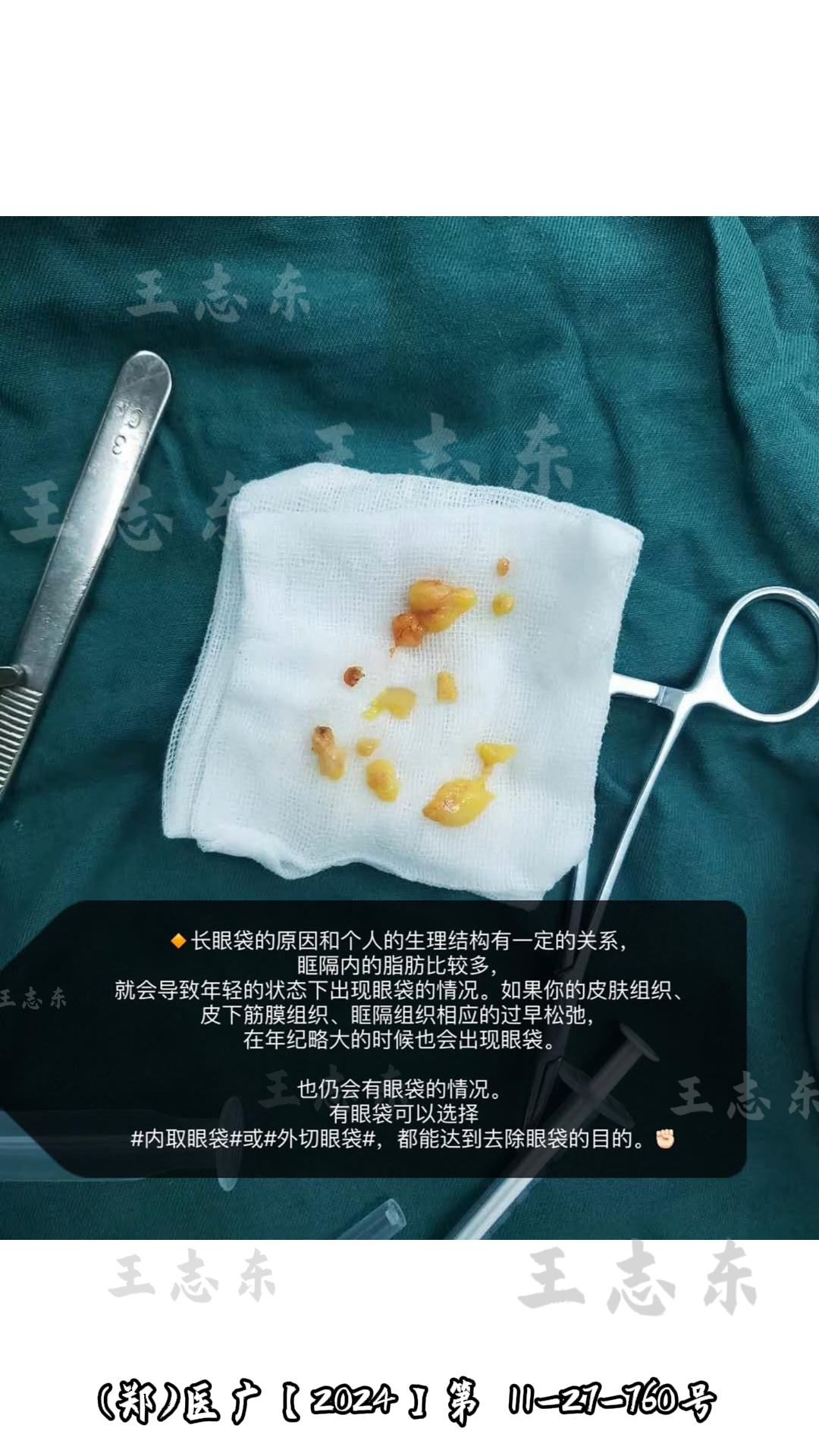 1.3眼袋2.png