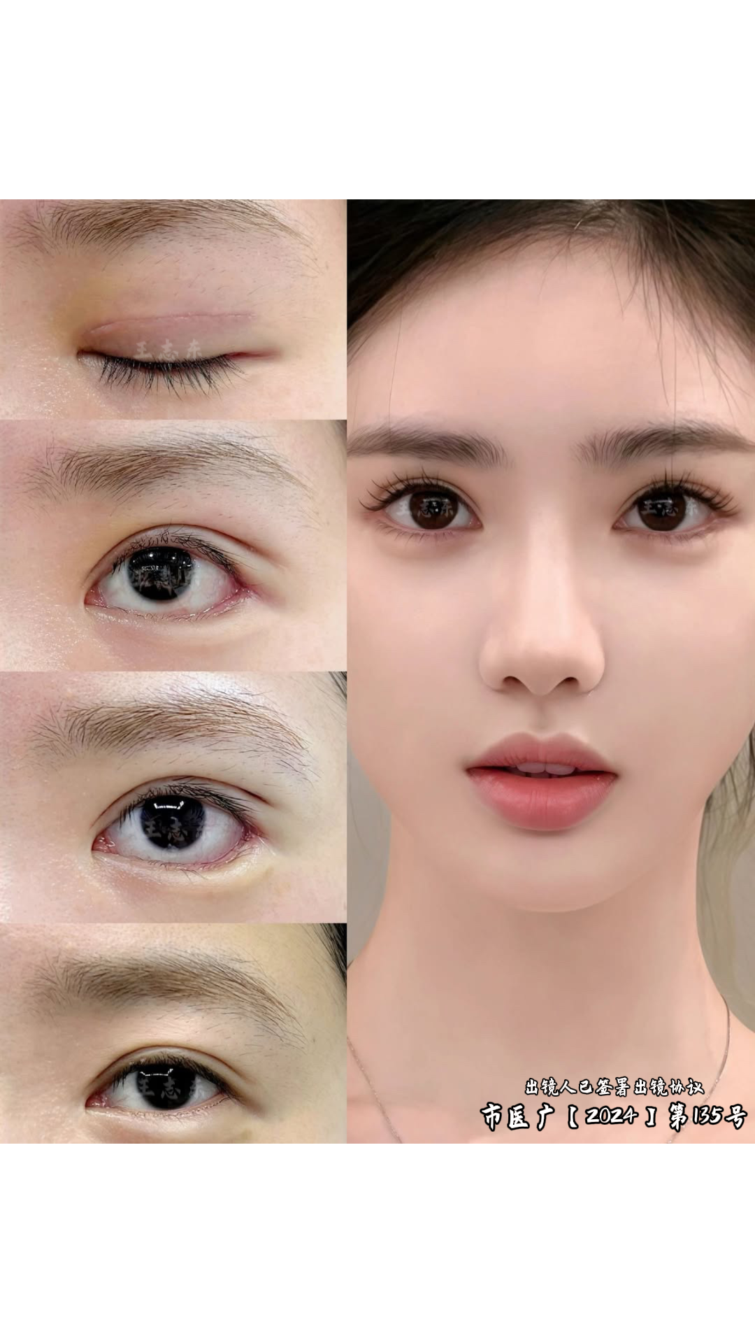 1.19双眼皮2.png