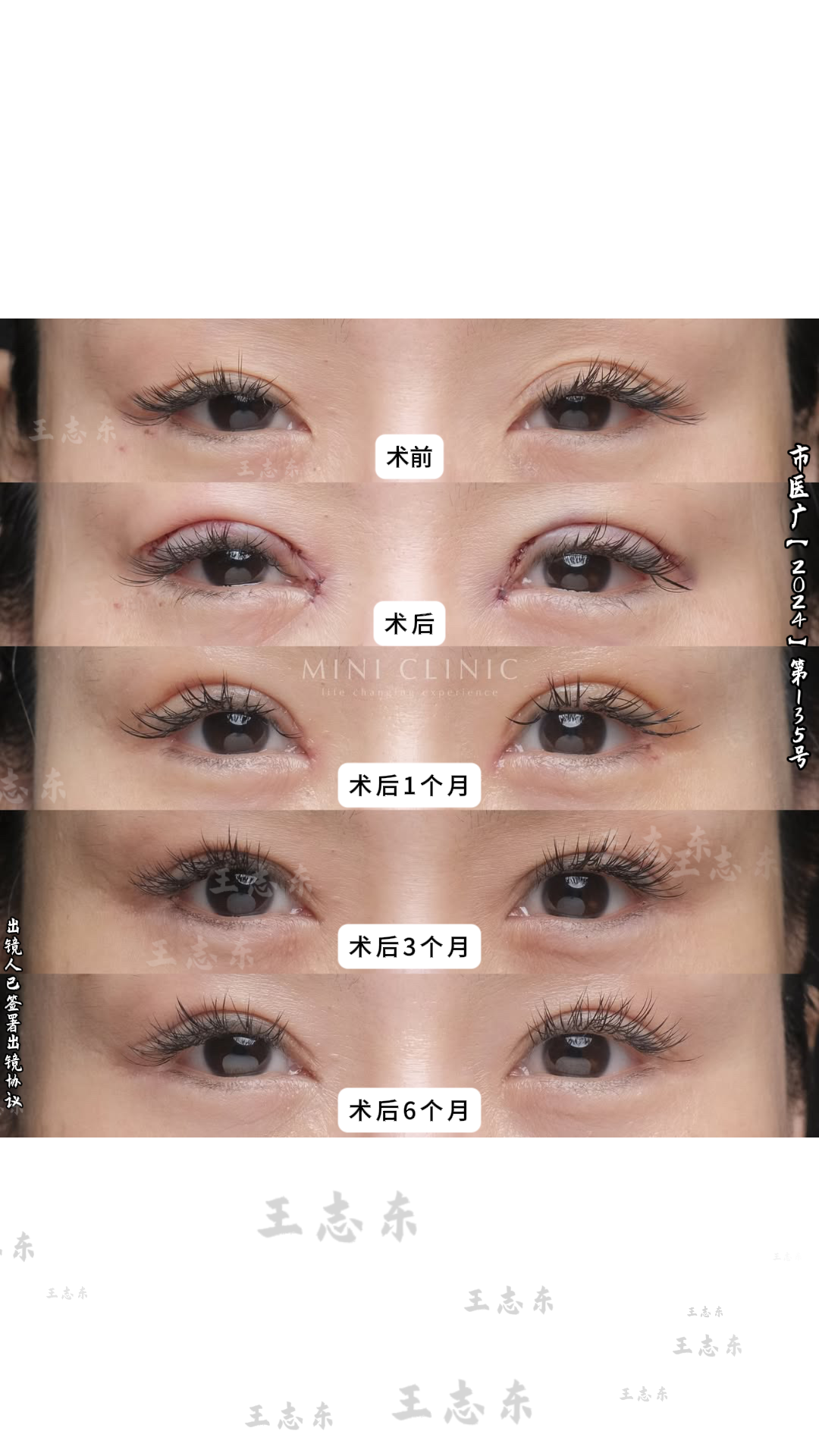 2.5双眼皮2.png