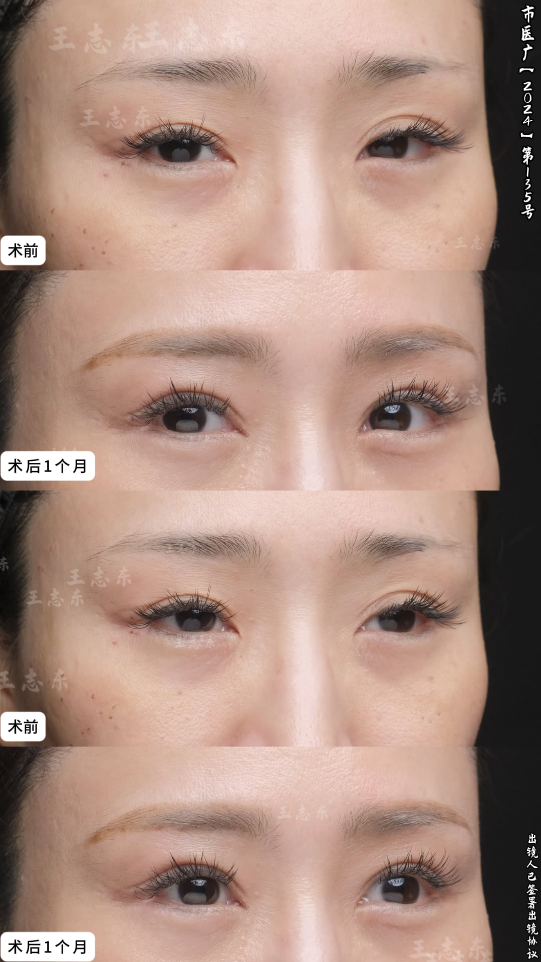 2.5双眼皮3.png
