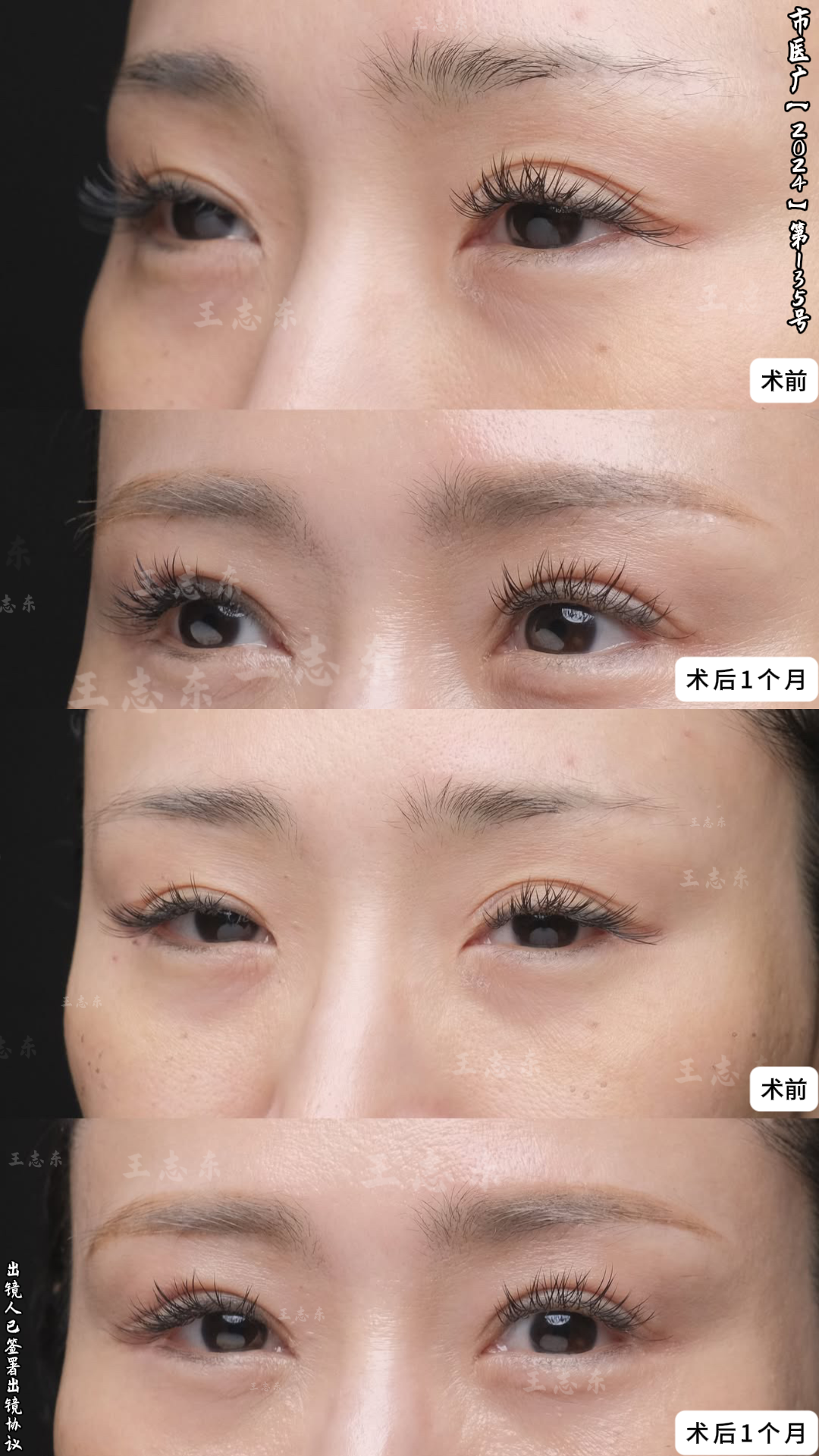 2.5双眼皮3.1.png