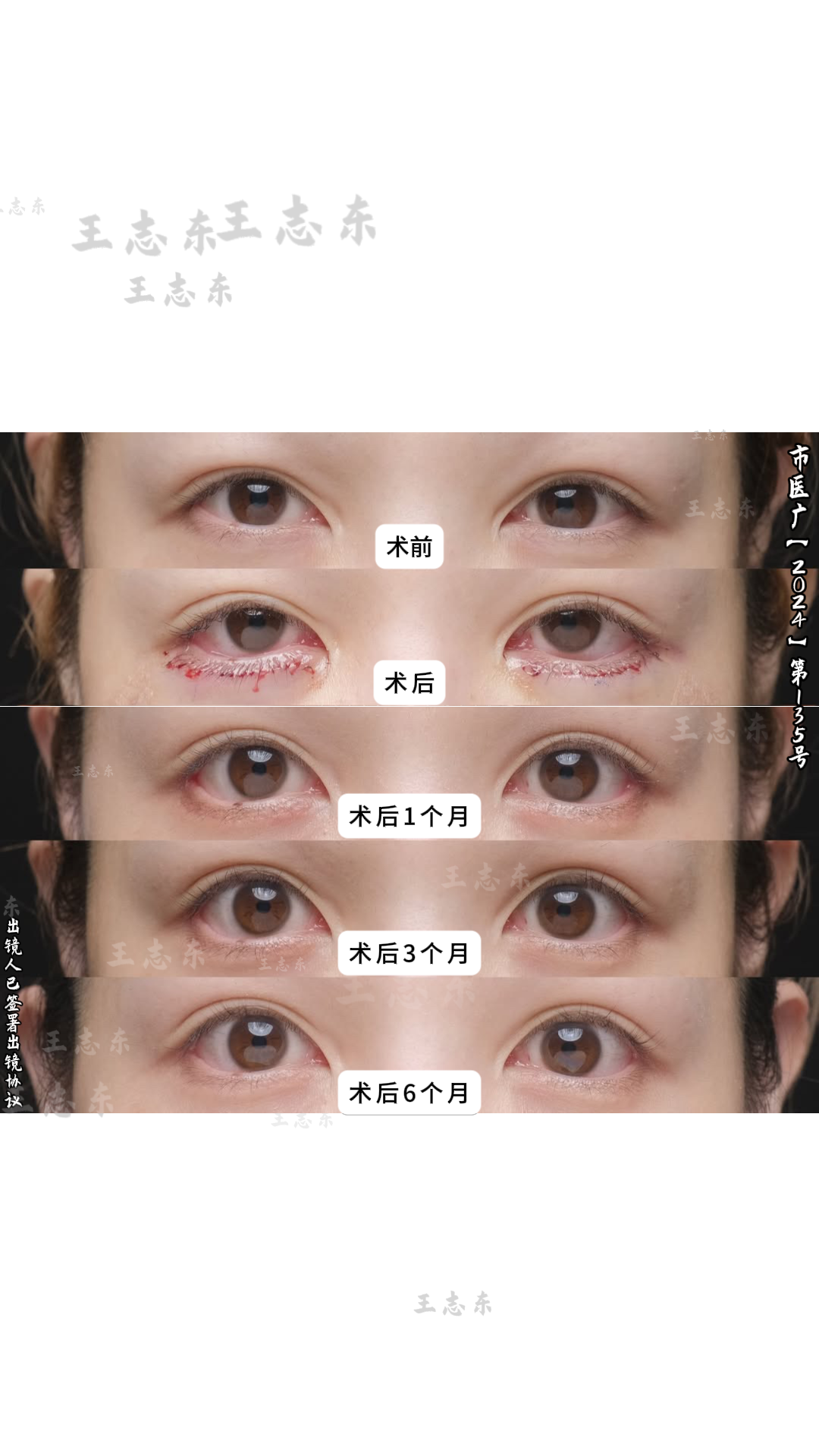 1.24双眼皮3.png