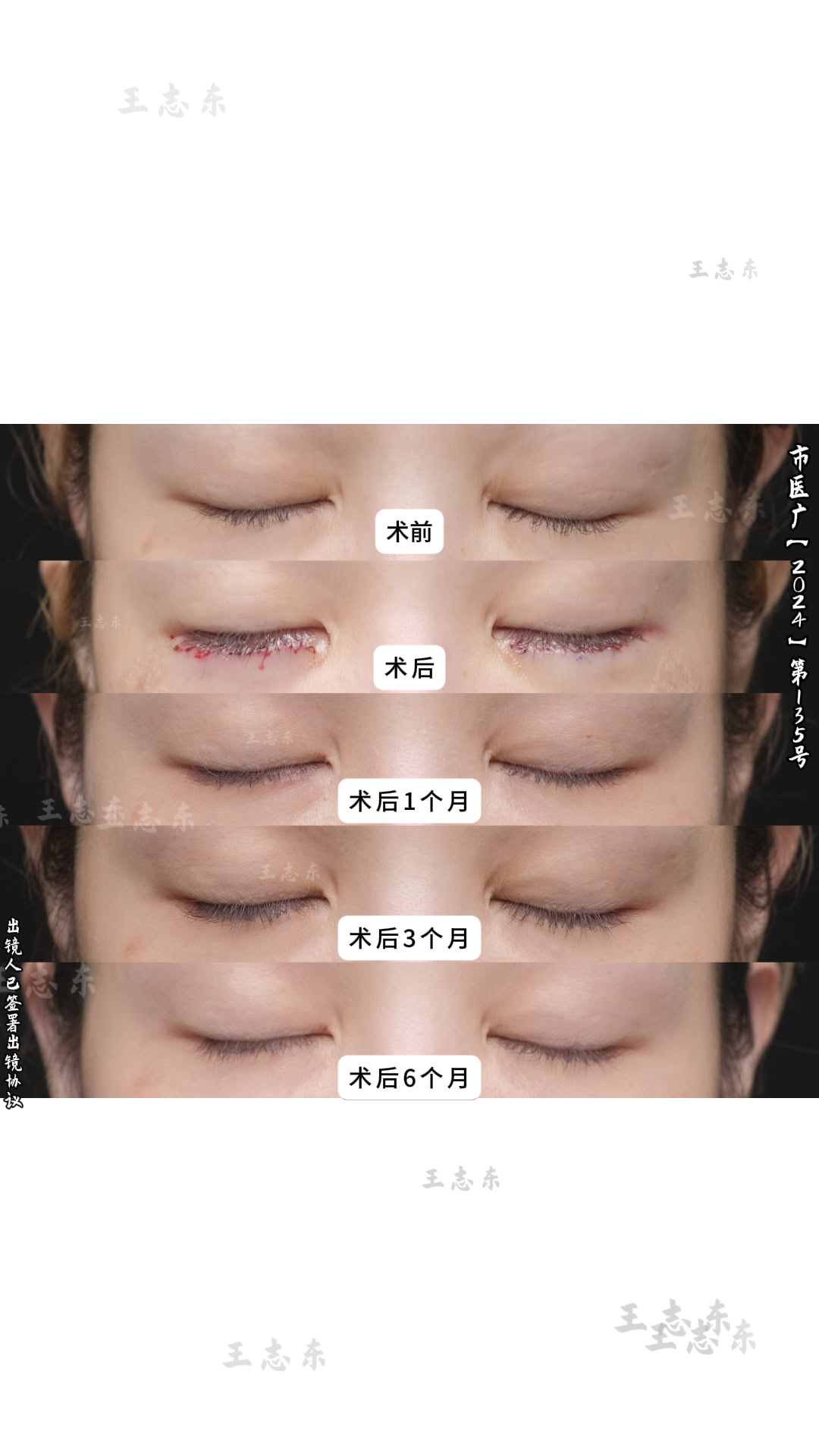 1.24双眼皮2.png