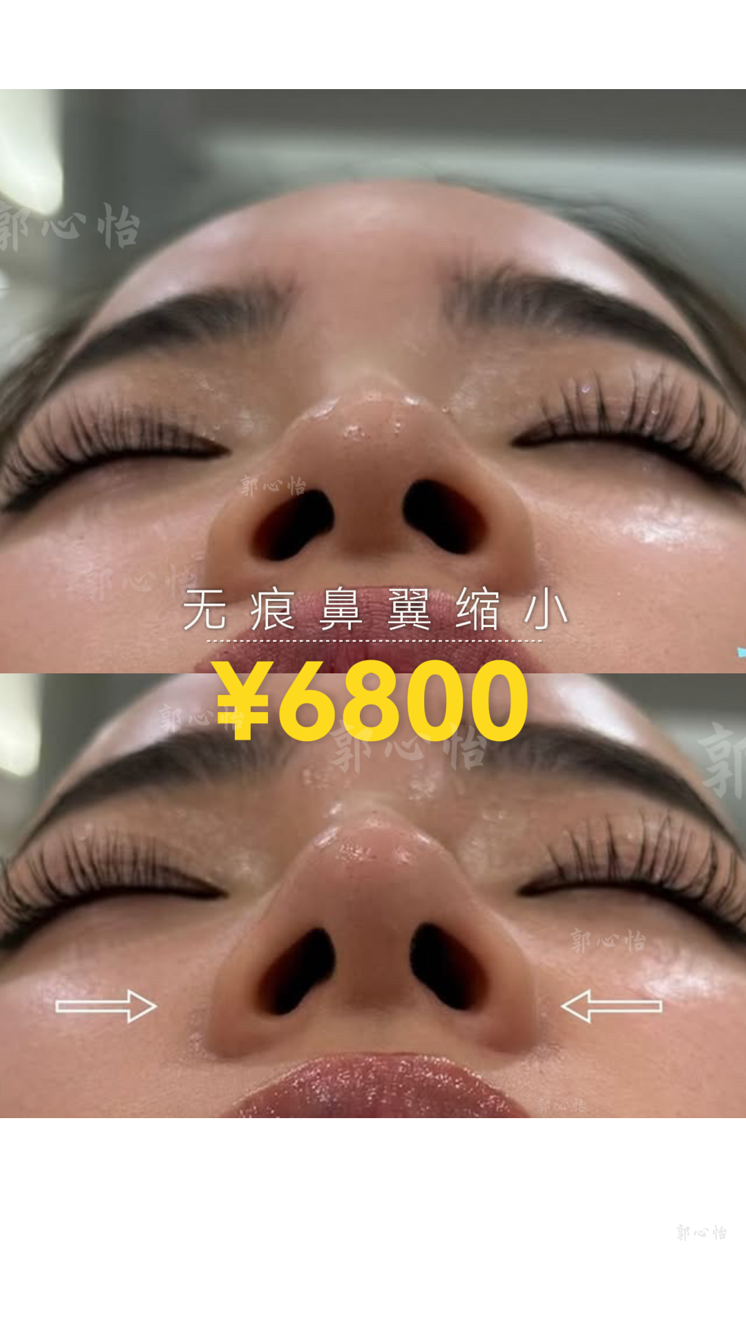 12.25鼻翼3.png