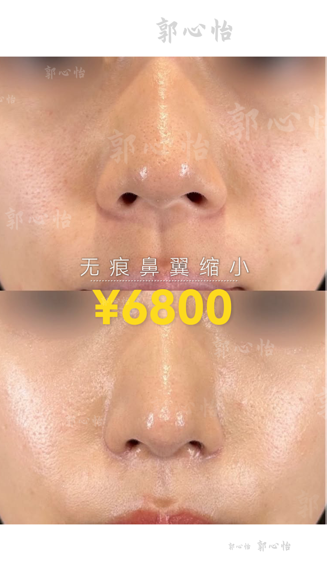 12.25鼻翼2.png