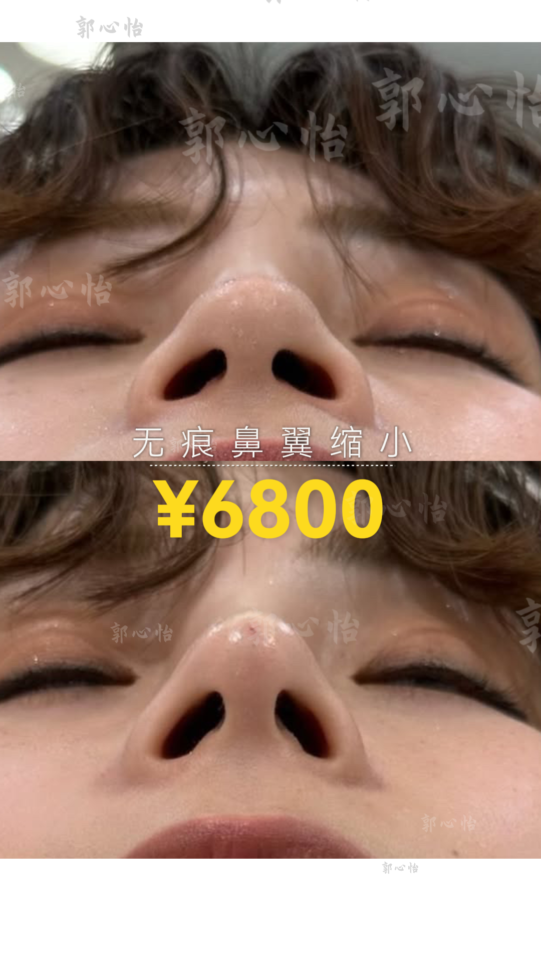 12.25鼻翼4.png