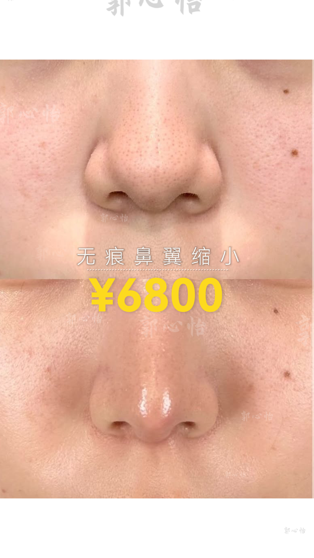 12.26鼻翼2.png