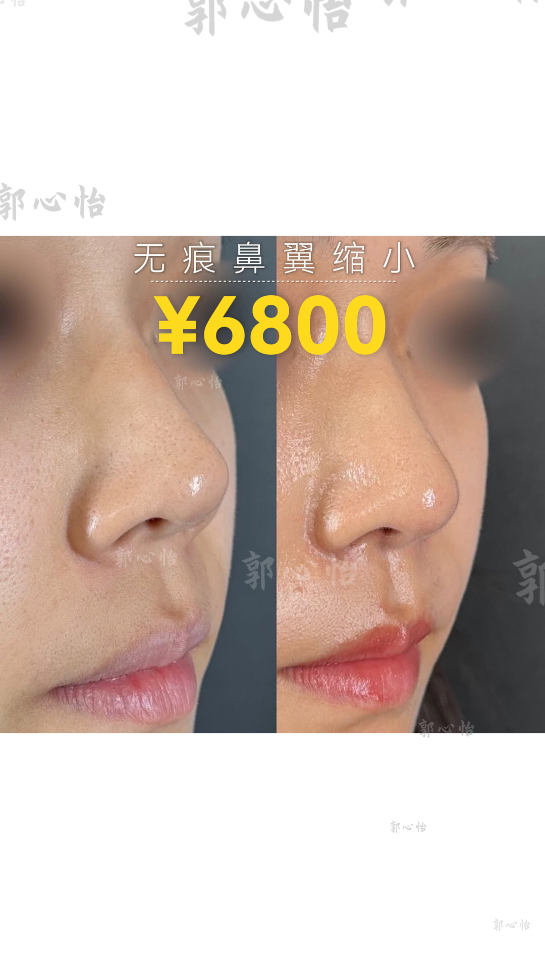 12.27鼻翼3.png