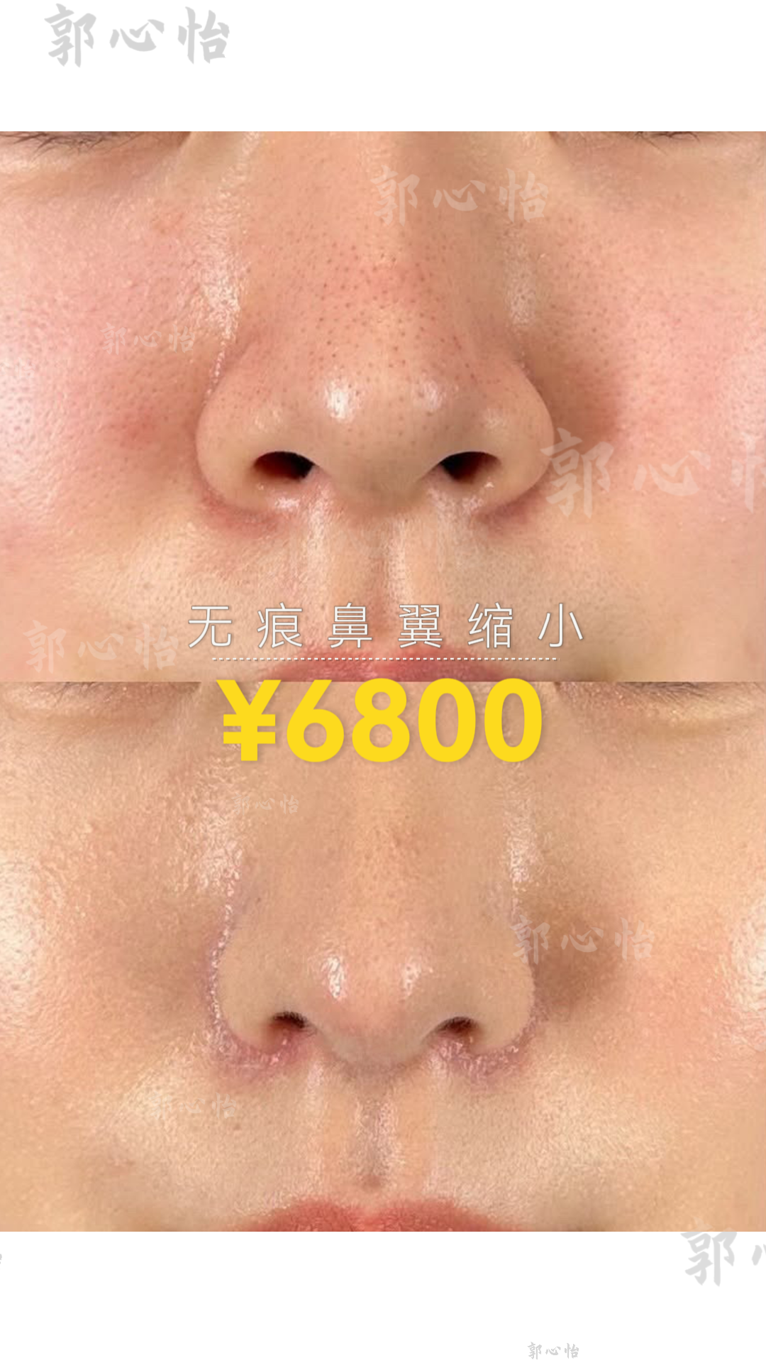 12.27鼻翼4.png