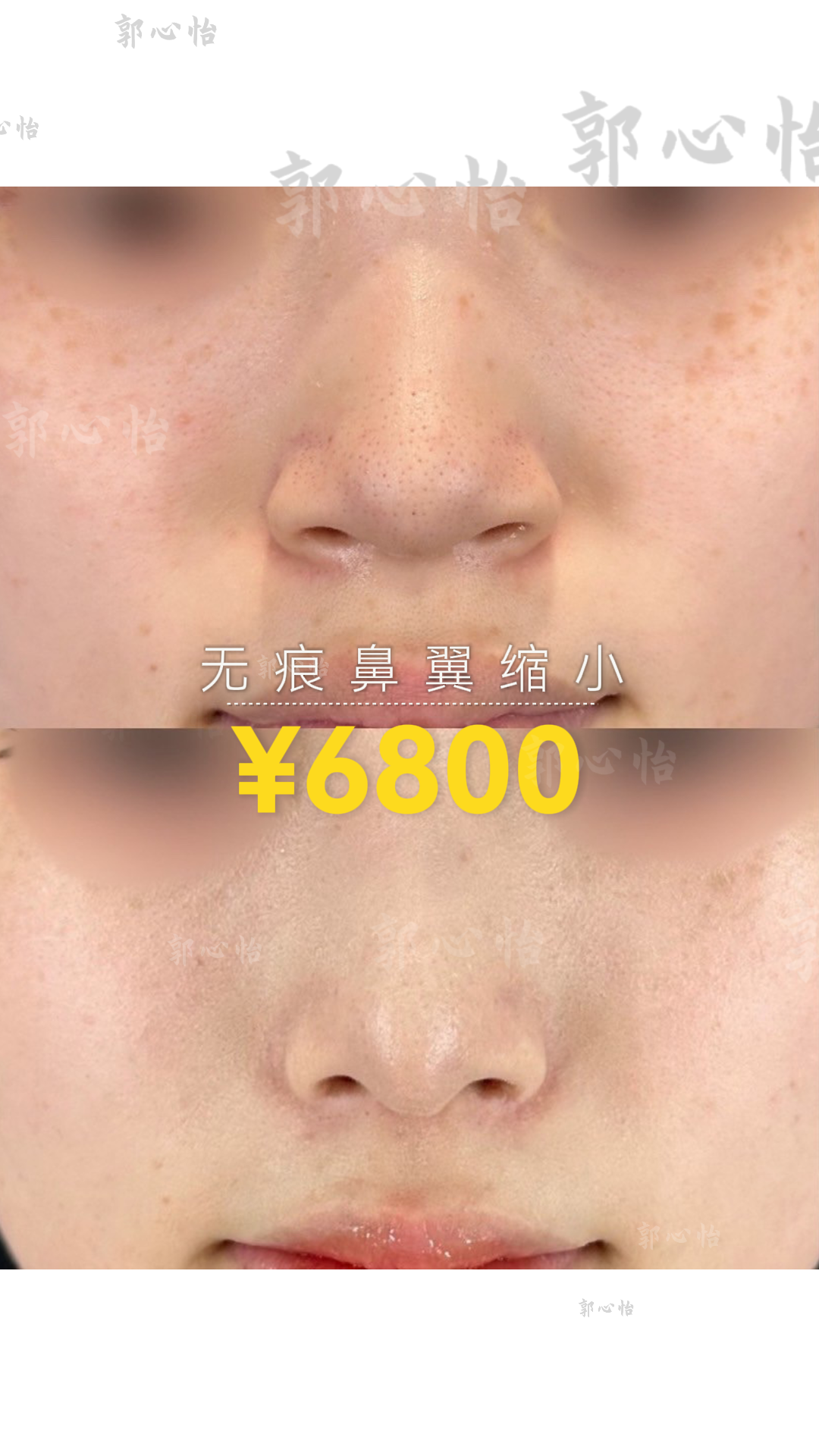 12.27鼻翼2.png